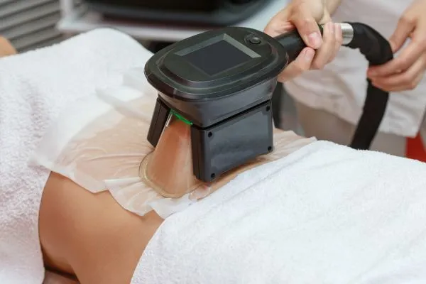 Image of person having fat freezing treatment to help weight gain Northolt