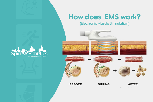 EMS treatment for post pregnancy weight loss treatment Northolt
