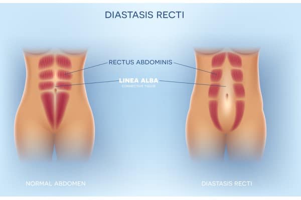 How Does Non-Surgical Treatment Help With Loose Skin, Weak Abdominal Muscles and Post-Pregnancy Changes Northolt?