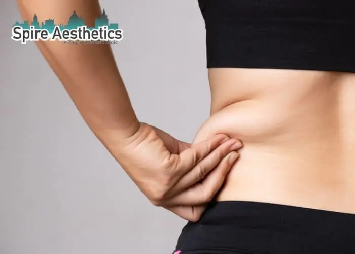 Image of woman pinching fat on their hips Northolt. Fat Freezing treatment
