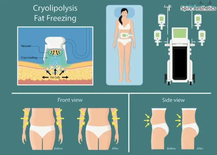 Fat freezing treatment Northolt benefits for competitions to remove stubborn fat deposits.
