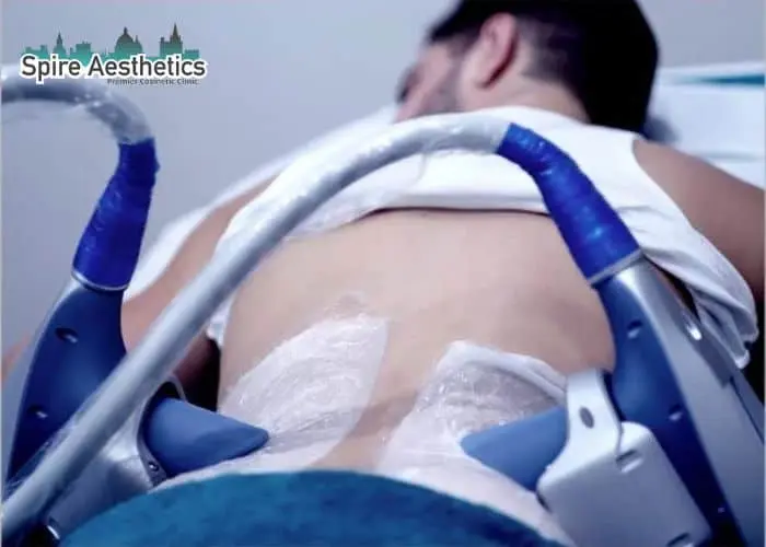 Man having fat freezing treatment done on love handles before a competitions Northolt to create a sculpted look.