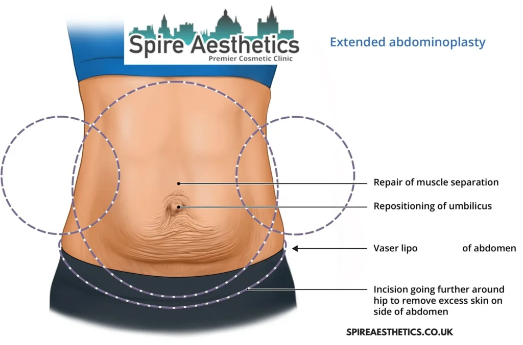 Understanding Loose Skin After Gastric Band Northolt Surgery and HIFU Treatment