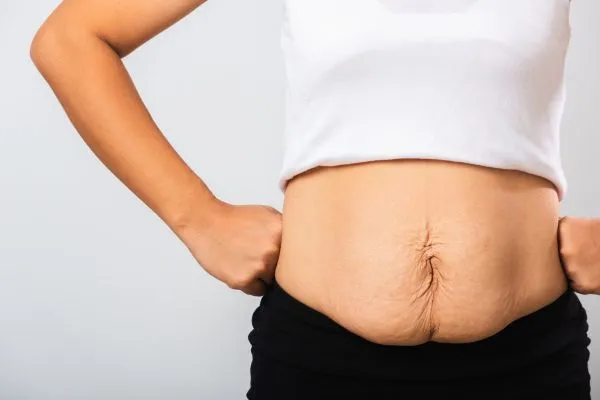 Image of a woman's stomach after weight loss with sagging skin following a gastric band Northolt