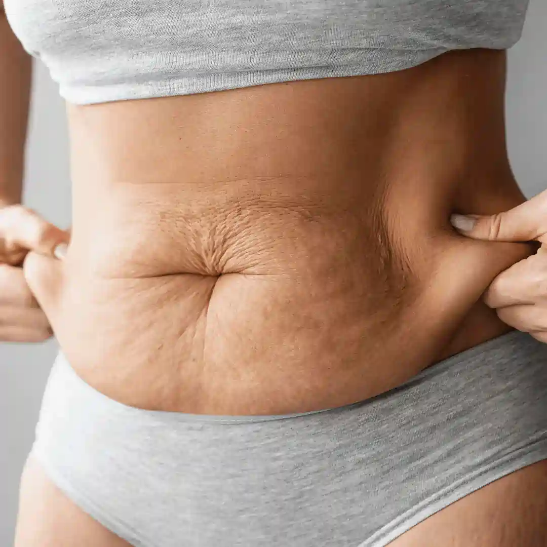 Is It Normal to Have Loose Skin After Pregnancy Northolt?