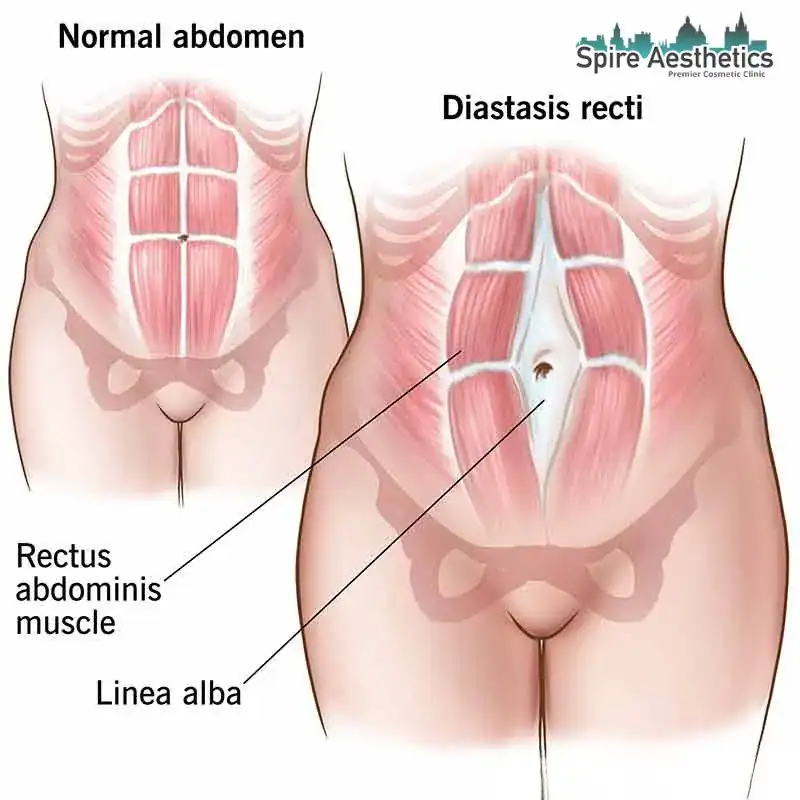 When Will My Belly Feel Normal Again Northolt?