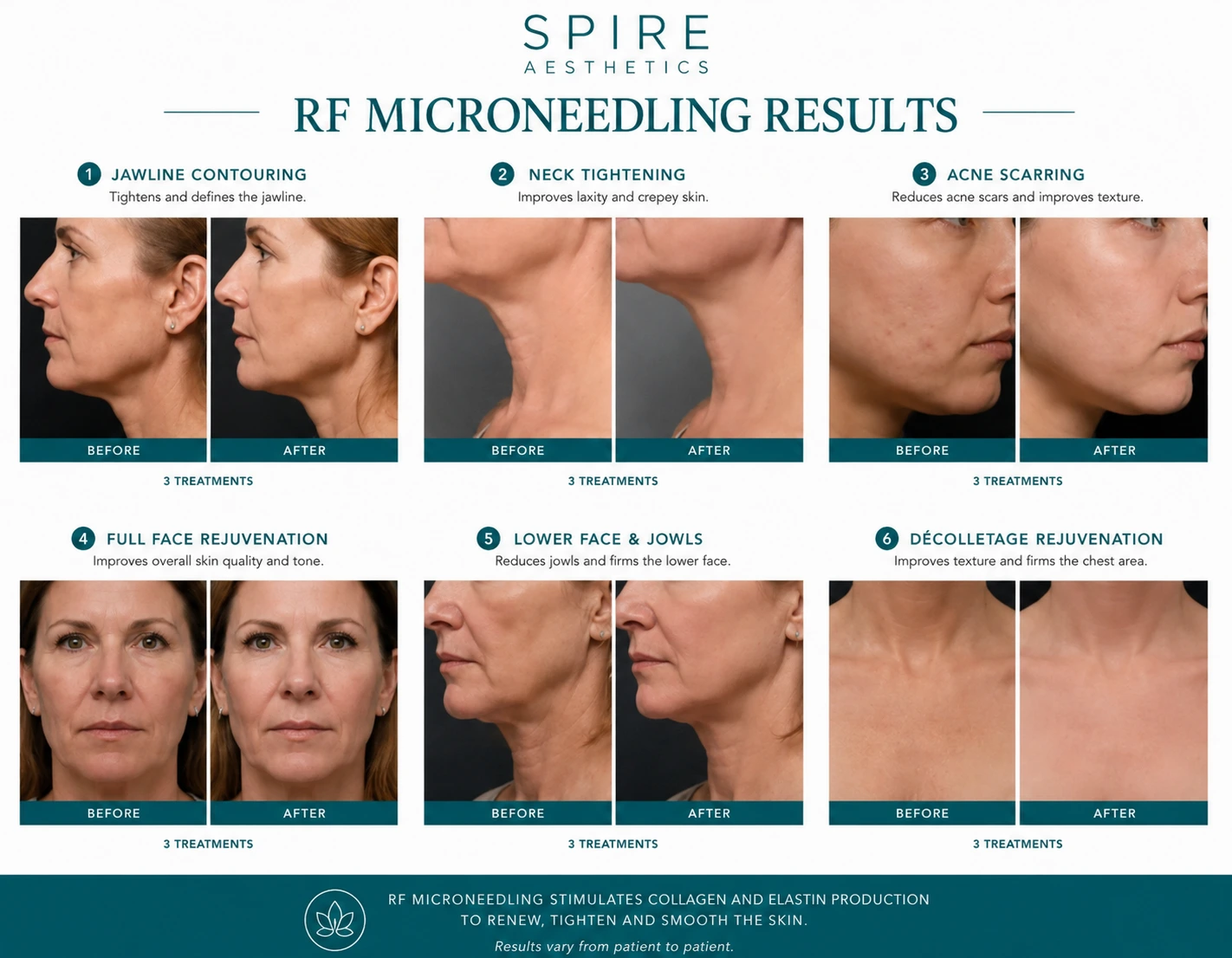 RF Microneedling Skin tightening Northolt results