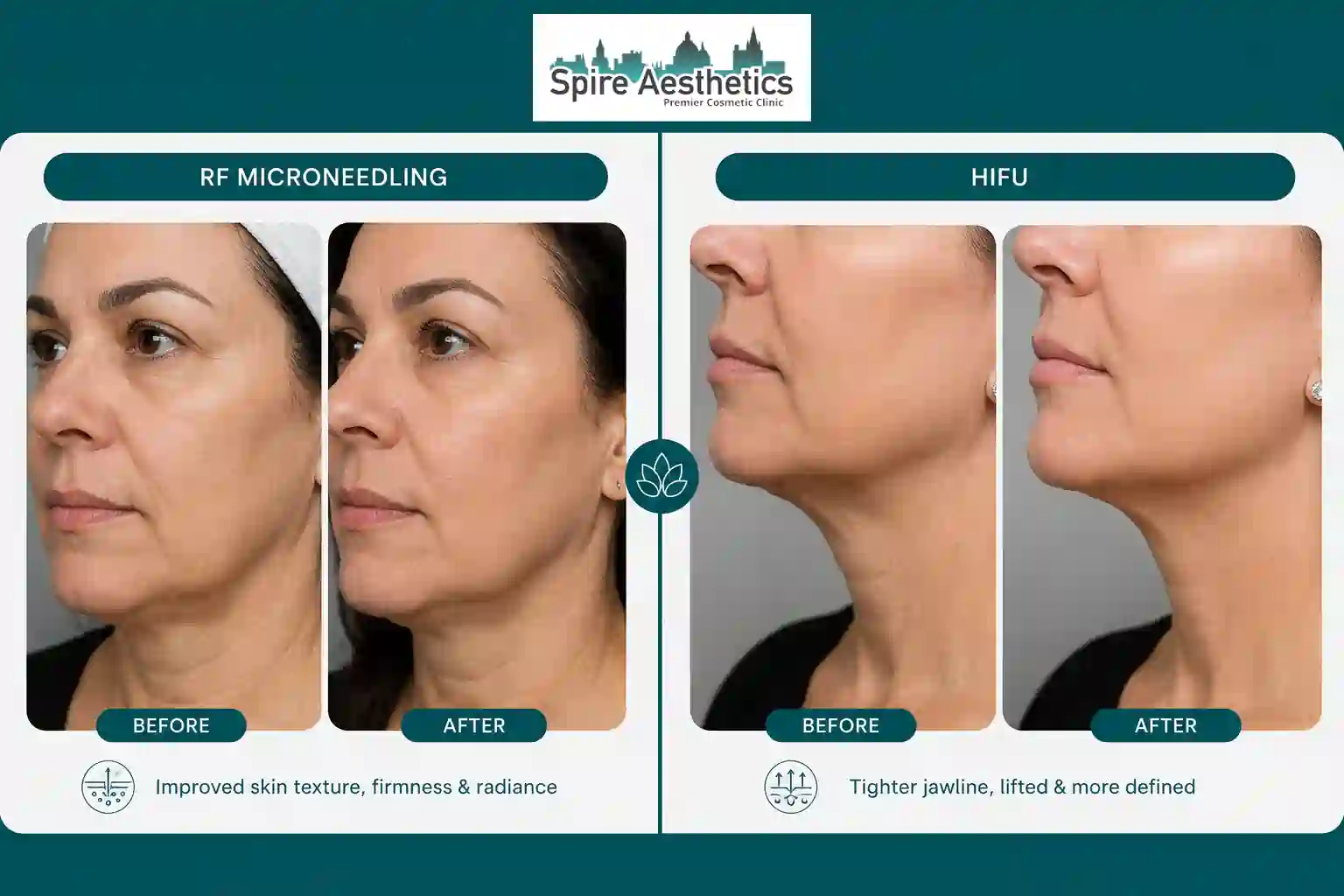 Can RF Microneedling and HIFU Be Combined Northolt?