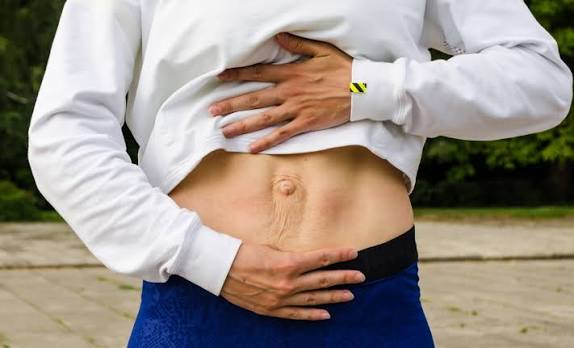 When Could Diastasis Recti Be the Missing Piece of the Puzzle Northolt?