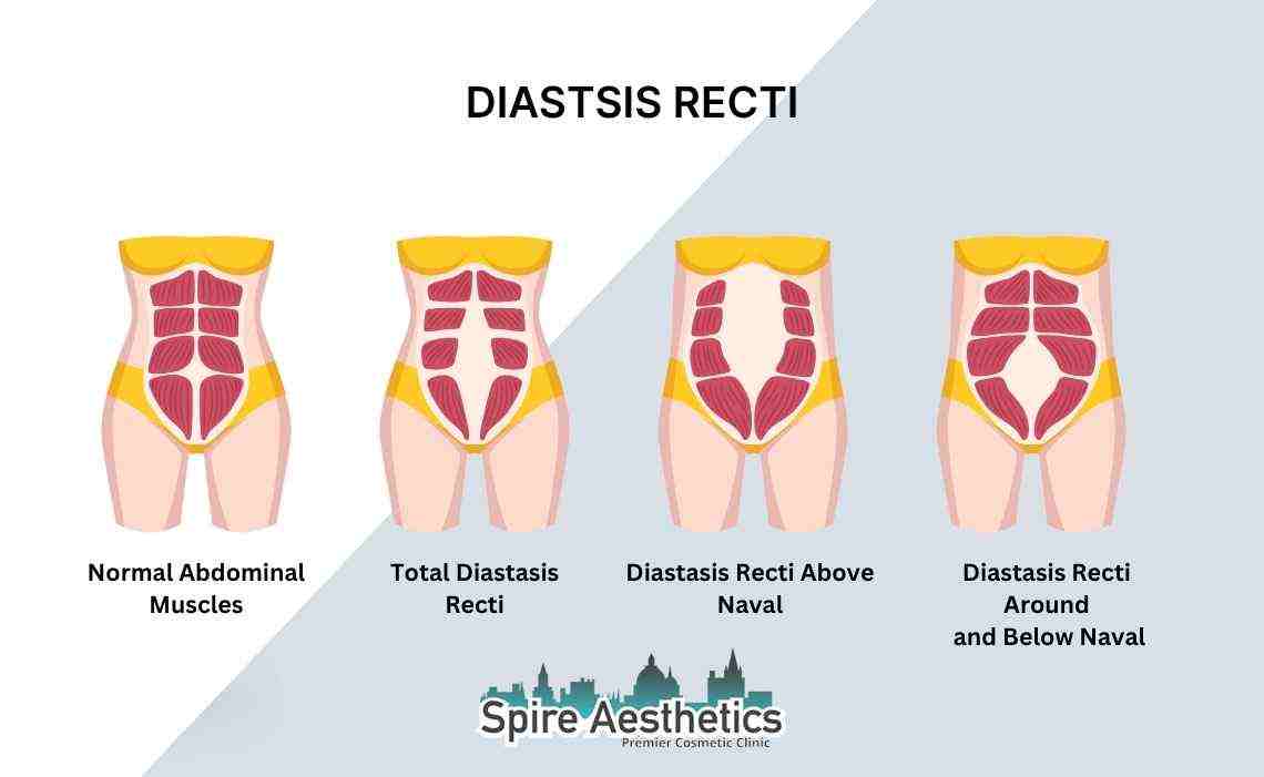 Is Non-Surgical Diastasis Recti Treatment Right for You? Common Concerns Answered Northolt